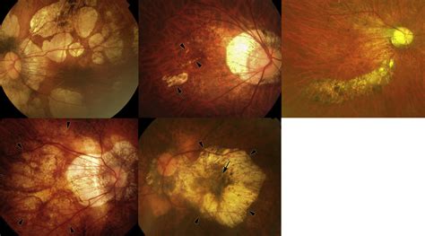 Macular Bruch Membrane Holes In Highly Myopic Patchy Chorioretinal Atrophy American Journal Of