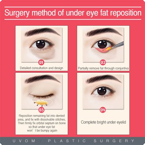 Under Eye Fat Re Positioning