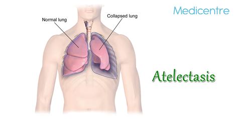 Atelectasis Causes Symptoms Treatments