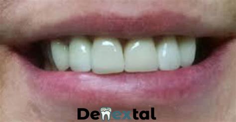 6 Front Teeth Crowns - A Comprehensive Guide - Denextal: Connecting ...