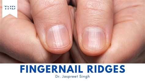 Do You Have Vertical Ridges On Your Fingernails Heres What They Mean