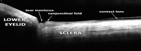 Oct Imaging Of Lid Parallel Conjunctival Folds In Soft Conta Optometry And Vision Science