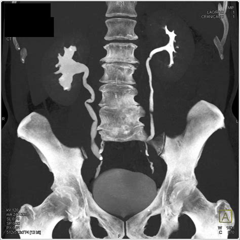 Right Hydronephrosis Due To A Stone In The Distal Right Ureter Kidney