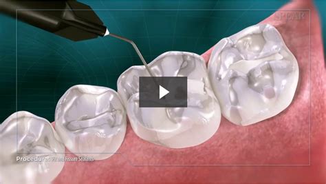 Pit and Fissure Sealants - Cosmetic Dentistry