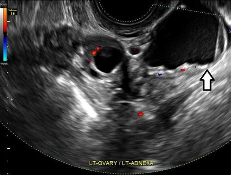 Transvaginal Ultrasound Of A Patient With Advanced Stage Endometriosis