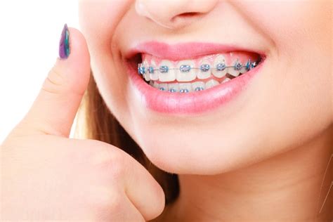 How Braces Work To Straighten Teeth