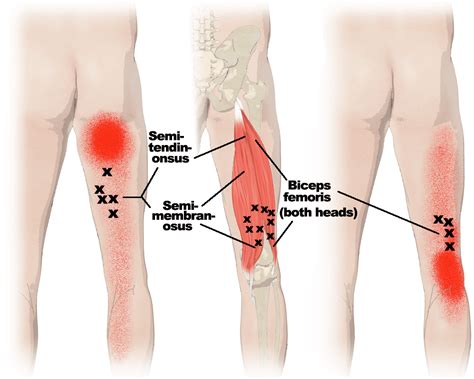 Hamstring Blessure Alle Info Op Een Rij Fysiotherapie All Nl