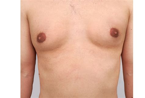 Gynecomastia Natural Ways To Manage Enlarged Breasts In Men