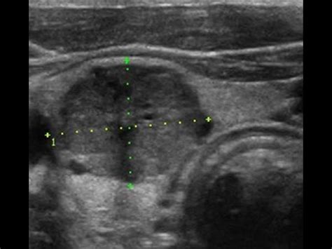 Medullary Carcinoma Thyroid Ultrasound