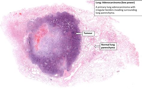 Lung Adenocarcinoma Nus Pathweb Nus Pathweb