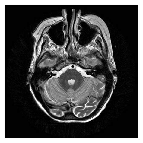 Magnet Resonance Imaging Axial T2 Weighted Images Showing Increased