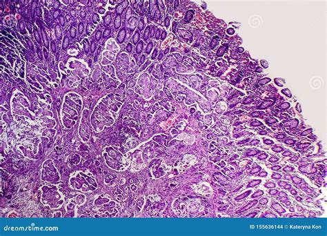 Poorly Differentiated Intestinal Adenocarcinoma Light Micrograph