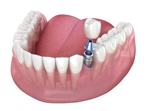 How Much Do Dental Implants Cost In Perth Wa Maloney Dental Care Service