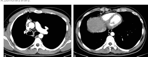 Figure From Imaging Diagnosis Of Isolated Proximal Interruption Of