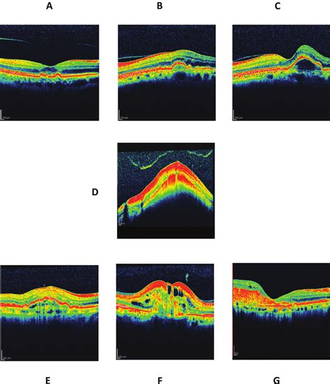 Representative Optical Coherence Tomography Images Of Patients In The