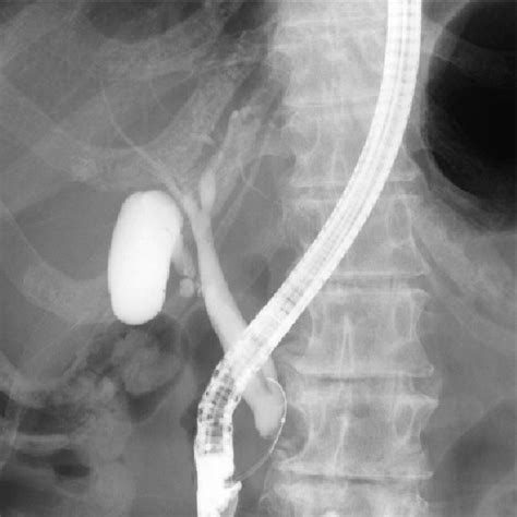 Endoscopic Retrograde Cholangiography Revealed Filling Defect In The