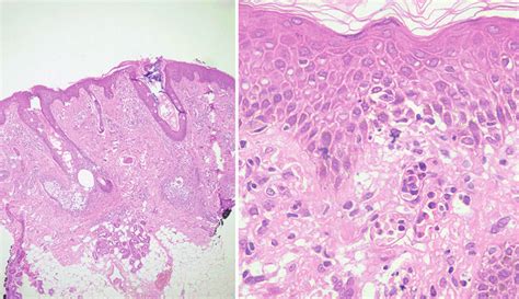 A And B Skin Punch Biopsy Of Face And Truncal Lesions Showed