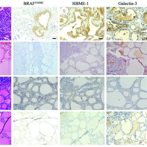 Immunohistochemistry Ihc Of Biomarkers For Papillary Thyroid