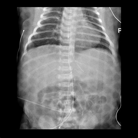 Pediatric Esophageal Temperature Probe Malfunction Pediatric