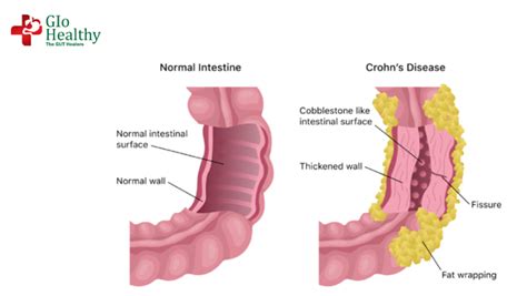 Crohns Disease Inflammatory Bowel Disease Crohns Disease Treatment