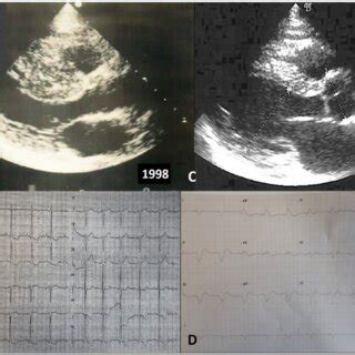 Echocardiographic And Electrocardiographic Findings In A Patient With