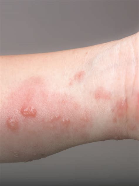 Shingles Signs You Must Not Ignore Happiest Health