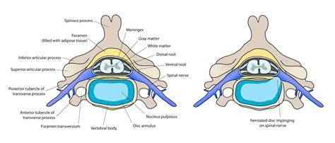 Intervertebral Disc Disease | Safari Veterinary in League City, TX