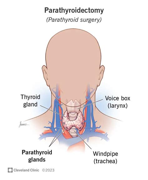 Parathyroidectomy: What It Is, Side Effects & Recovery