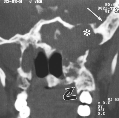 Fibrous Dysplasia Involving The Base Of The Skull Ajr