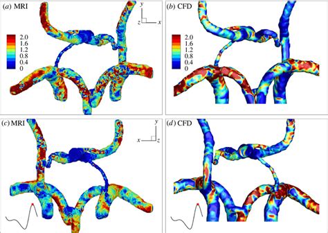 Normalized Wall Shear Stress Wss Wssmean At The Peak Systole As