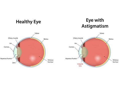 Astigmatism: Causes, Symptoms, Diagnosis, and Treatment