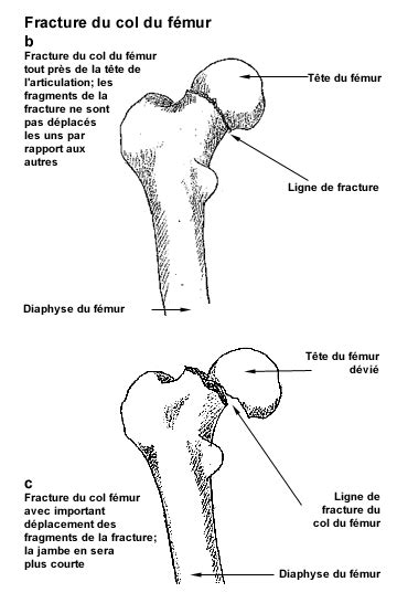 Definition De La Fracture Du Col Du Fémur