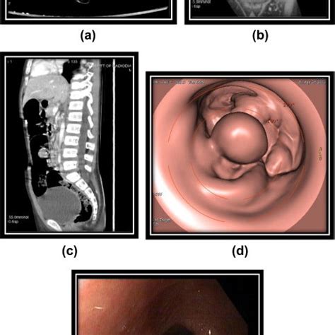 Pedunculated polyp in a 5-year-old male child histologically proven as... | Download Scientific ...