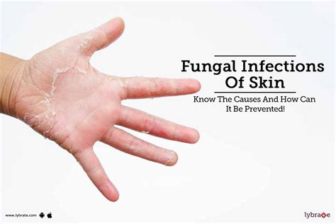 Fungal Skin Cancer