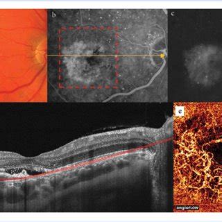 Clinical case 3, neovascular AMD (type 2 CNV). | Download Scientific Diagram