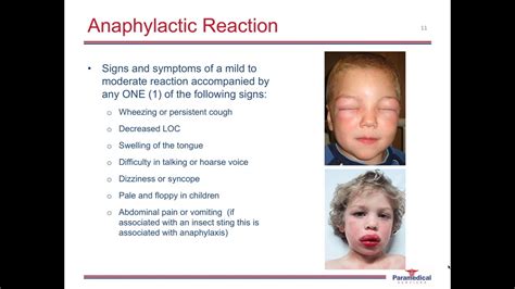 Allergy and Anaphylaxis - YouTube