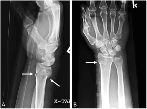 Distal Radius Fracture Wikipedia 59 OFF Pinnaxis