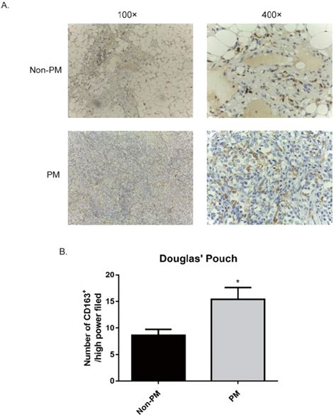 Gc Patients With Peritoneal Metastasis Had An Increased Number Of Cd163 Download Scientific