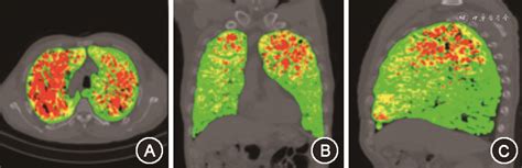 基于吸呼双相ct定量参数的慢性阻塞性肺疾病影像学表型研究 中华医学杂志