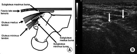 Hip Bursitis Injection