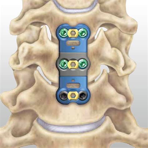 Cervical Esi For Herniated Disc