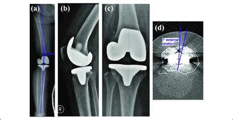 Postoperative images of the right knee: (a) postoperative tibiofemoral ...