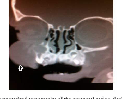 Figure From Pediatric Fibroma In Maxillary Sinus Following Nasal