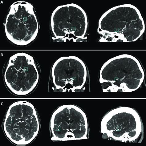 Algorithm Output Of Three Patients Showing Maximum Intensity Projection