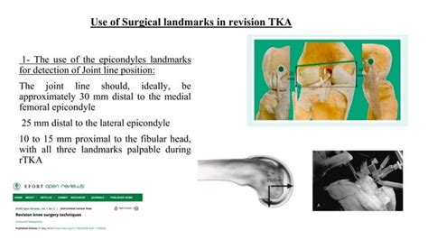 Surgical Landmarks In Revision Total Knee Ppt