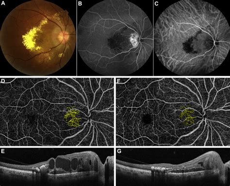 Retinal Capillary Hemangioma