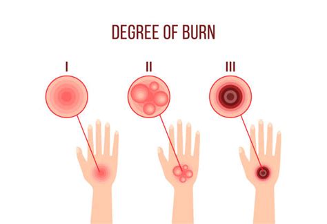 Difference Between 1st 2nd And 3rd Degree Burns