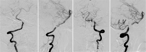 Vertebral Artery Angiogram Vag Before And Just After Stent Assisted