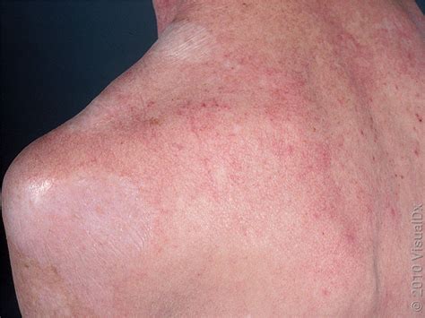 Lichen Sclerosus Fora Dermatology General Surgical Dermatology In