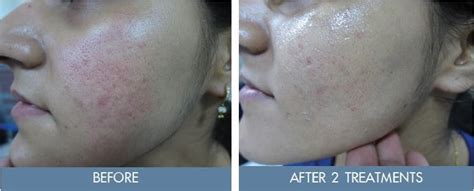 MCL31 Dermablate Er YAG Laser Fractionalskin Rejuvenation